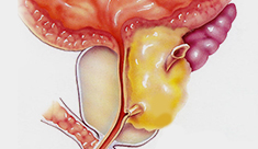 Efectes del càncer de pròstata: disfunció erèctil i incontinència urinària.