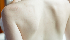 Cicatrices después del cáncer de piel: ¿Hay remedio?